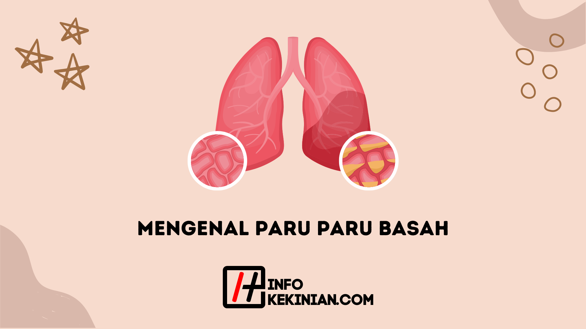 Mengenal Paru Paru Basah Pengertian Gejala Dan Penyebabnya