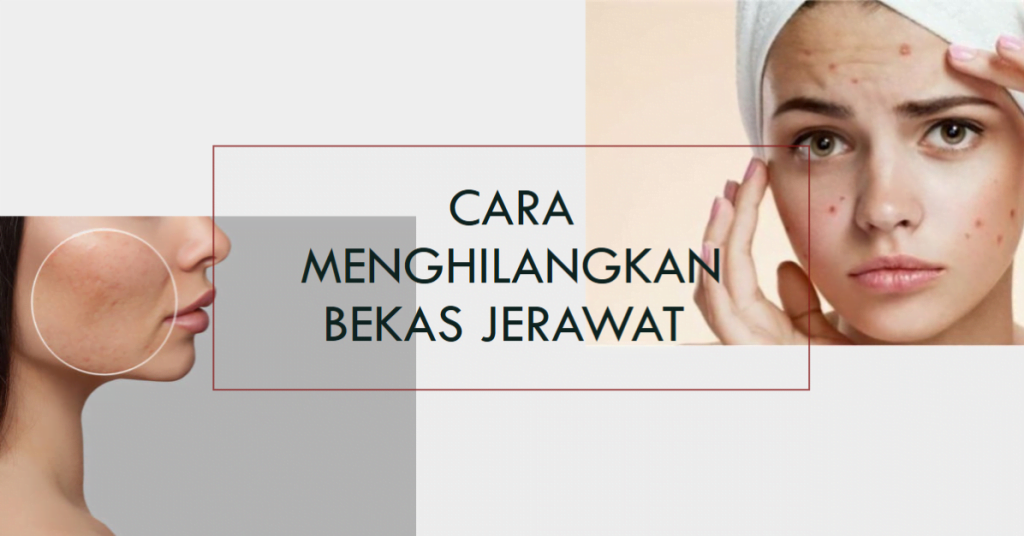Cara Alami Menghilangkan Bekas Jerawat Merah