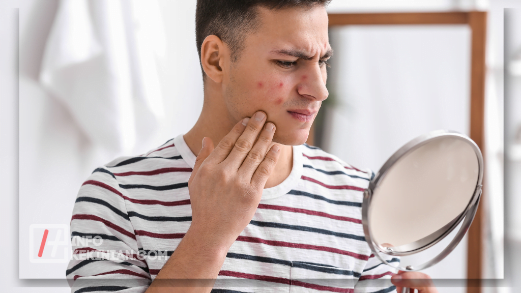 7 Cara Menghilangkan Minyak di Wajah Secara Alami untuk Pria yang Wajib Dicoba! 2 Masalah yang Timbul Akibat Kulit Berminyak