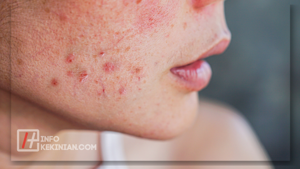Menentukan Jenis-Jenis Jerawat