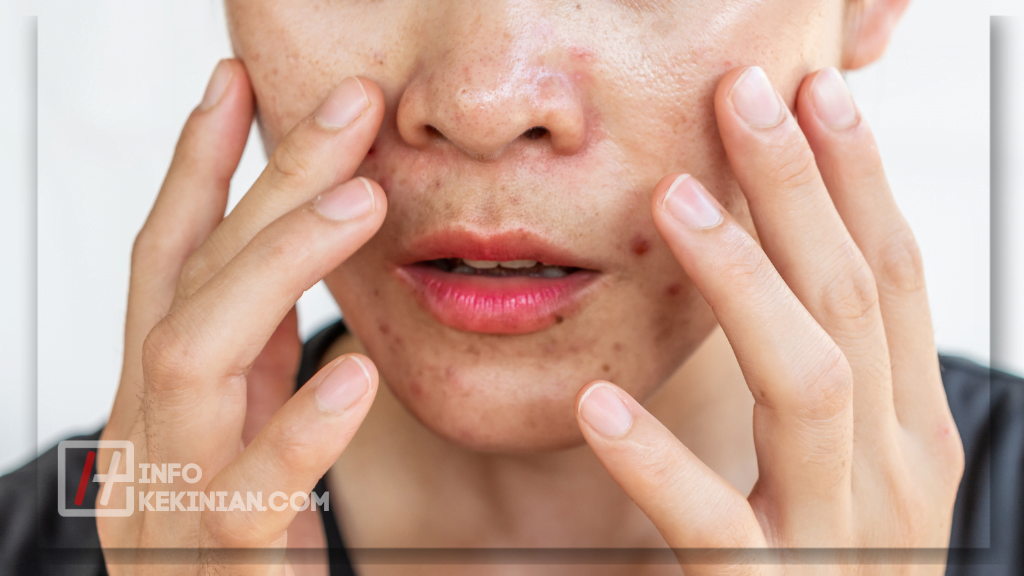 7 Cara Menghilangkan Minyak di Wajah Secara Alami untuk Pria yang Wajib Dicoba! 1 Penyebab Kulit Berminyak pada Pria