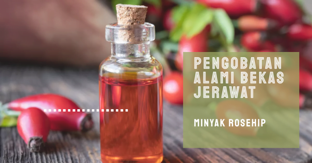 Pengobatan Alami Bekas Jerawat