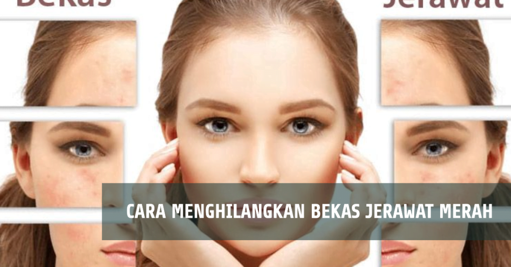 Cara Menghilangkan Bekas Jerawat Merah