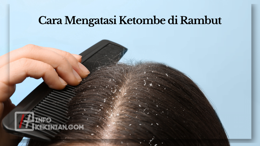 7 Cara Mengatasi Ketombe Yang Membandel Dengan Mudah Dan Efektif 3663