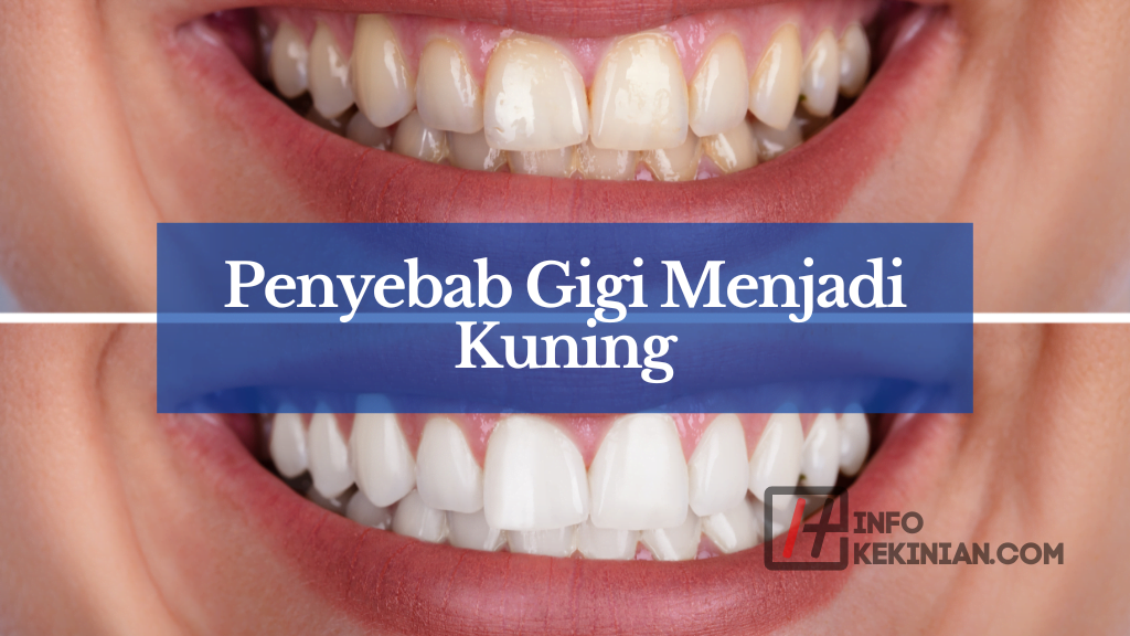 Penyebab Gigi Menjadi Kuning