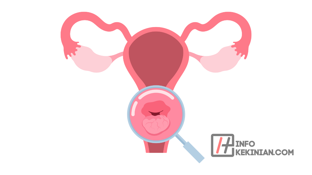 Gejala Kanker Serviks Stadium Awal yang Perlu Dikenali