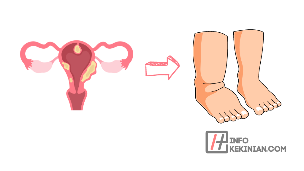 Gejala Kanker Serviks