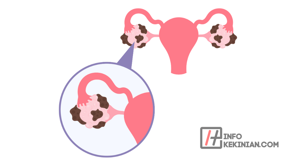 Apa Itu PCOS pada Wanita