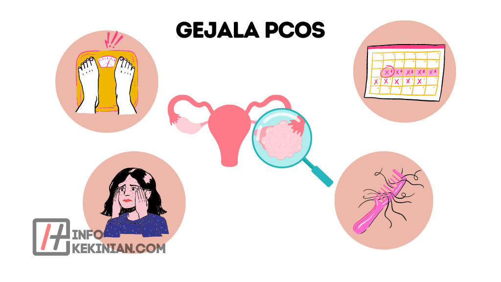 Gejala PCOS